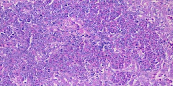 Role of histopathological examination in diagnosis of avian leucosis virus subtype J in broiler chicken in Egypt - Image 8