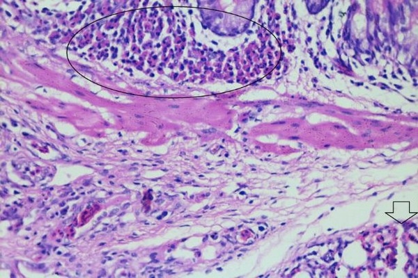 Role of histopathological examination in diagnosis of avian leucosis virus subtype J in broiler chicken in Egypt - Image 19