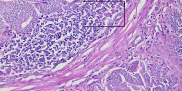 Role of histopathological examination in diagnosis of avian leucosis virus subtype J in broiler chicken in Egypt - Image 27