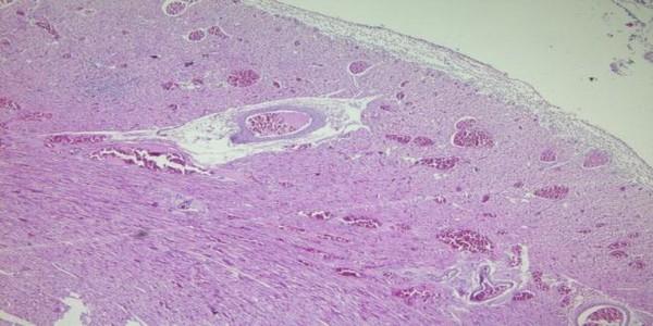 Role of histopathological examination in diagnosis of avian leucosis virus subtype J in broiler chicken in Egypt - Image 14