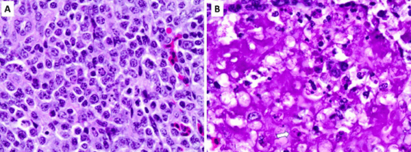 Newcastle Disease Virus Induces Profound Lymphoid Depletion with Different Patterns of Necroptosis, Necrosis, and Oxidative DNA Damage in Bursa, Spleen, and Other Lymphoid Tissues - Image 3