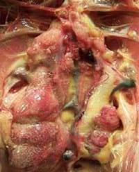Gout, a burning issue - Image 1