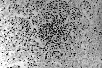 Demonstration of Listeria monocytogenes by Immunohistochemistry in Formalin-Fixed Brain Tissues from Natural Cases of Ovine and Bovine Encephalitis - Image 3