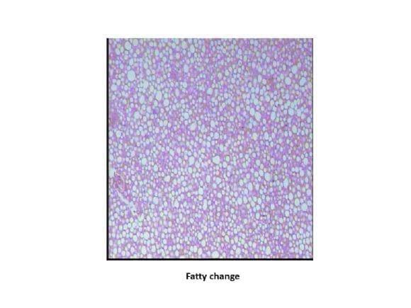 Fatty change