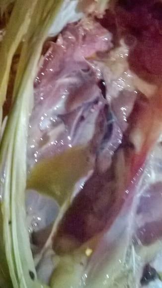 Clotted blood in the vesels of the kidney