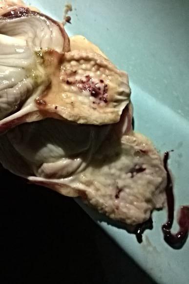Erosion & clotted blood on the glands & in between the spaces of the glands,thread like clotted blood drawn from the vesel of the liverproventriculus