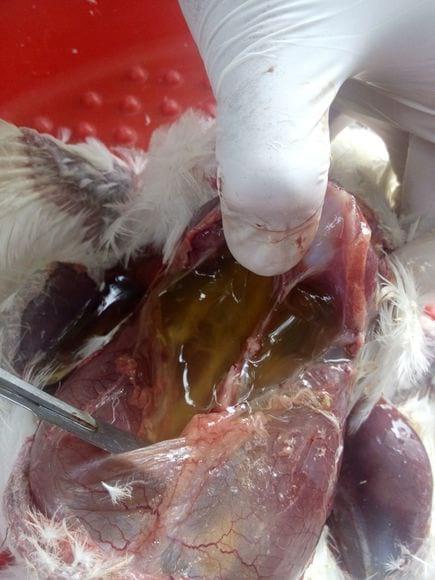 Abdominal dropsy or Ascites