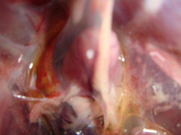Pericarditis