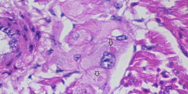 Role of histopathological examination in diagnosis of avian leucosis virus subtype J in broiler chicken in Egypt - Image 15