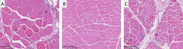 Figure 8. Micrographs showing damaged fibers in breast muscle tissue from 42 d old Ross 308 broilers. Samples with predominately normal fibers at 10x resolution (B) were assigned a 1 score for analysis. Samples with 33% or more abnormal fibers at 10x resolution (C) were assigned a 2 score for analysis. Analysis of damaged fibers found within the samples was used to determine if in ovo creatine prevented the development of abnormal muscle fibers.