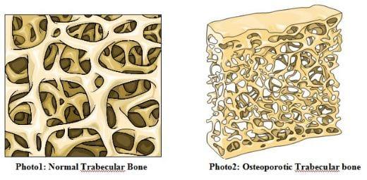 Metabolic Bone Disorder. Cage Layer Osteoporosis - Image 2